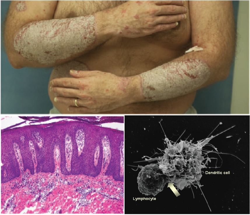 Psoriasis: A Window to the Human Immune System