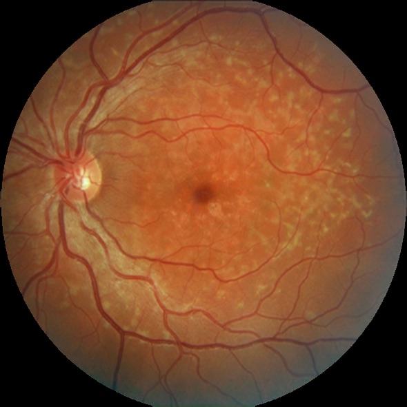 Attempts at Developing a Drug to Prevent Retinal Degeneration and Blindness:Stargardt&#39;s Disease and Age-related Macular Degeneration