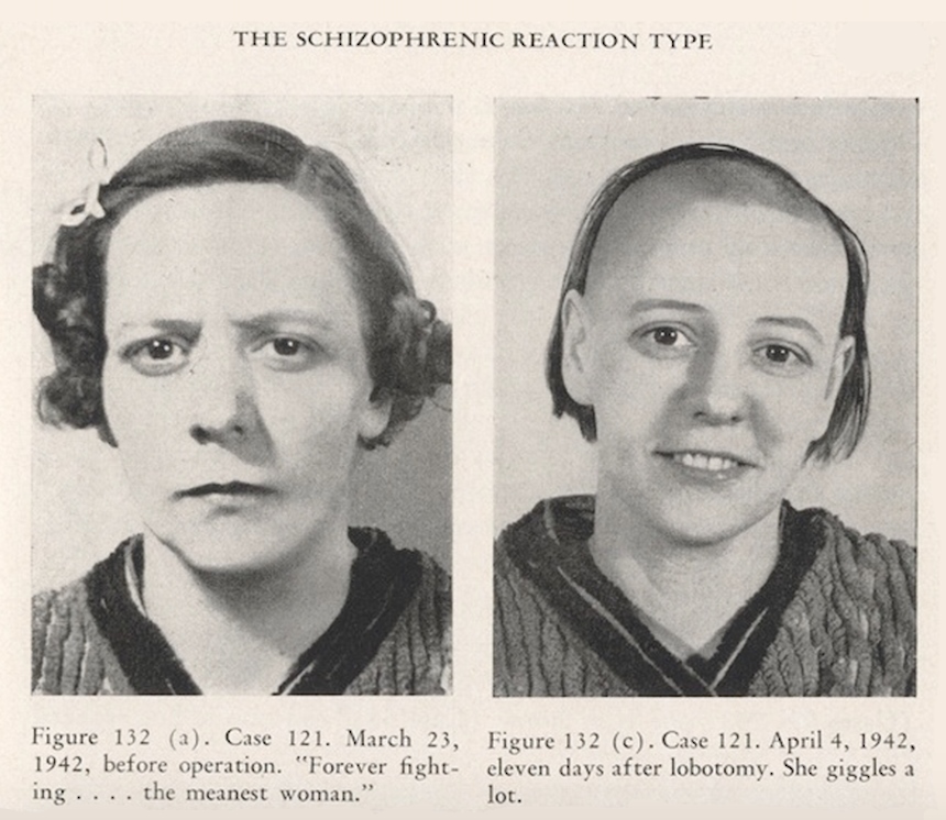 Head-and-Shoulder-Hunting in the Americas: Walter Freeman and the Visual Culture of Lobotomy