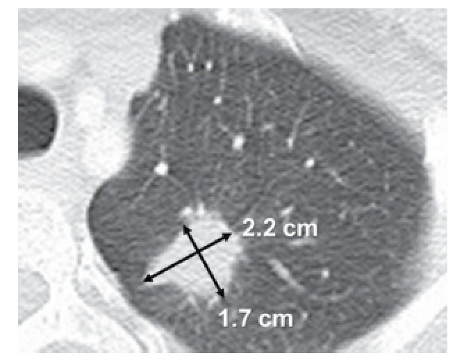 Bottleneck in the Drug Pipeline?Alternative Tumor Measurement-based Phase II Clinical Trial Endpoints for Predicting Overall Survival